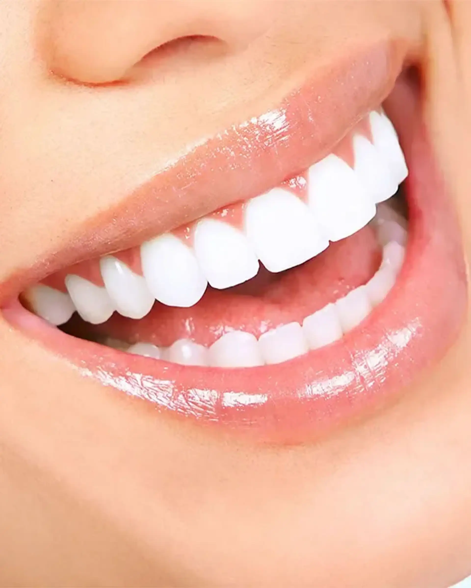 Veneer Process