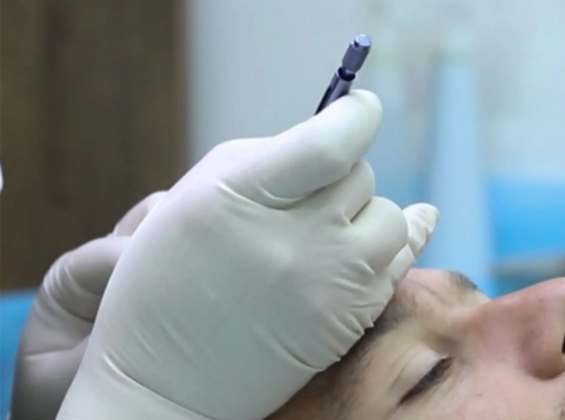 Técnica de Transplante Capilar Sapphire FUE