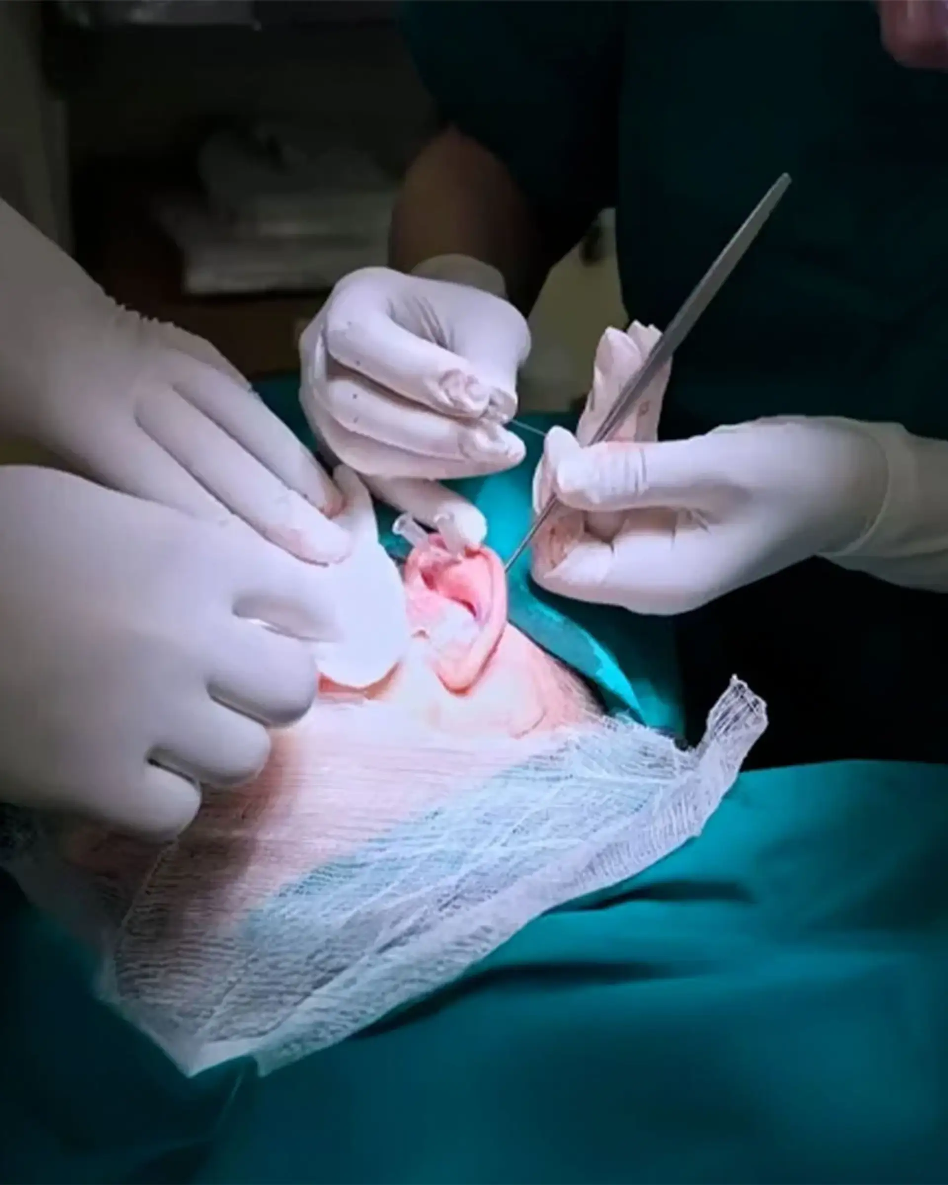 What to Expect at an Otoplasty Consultation