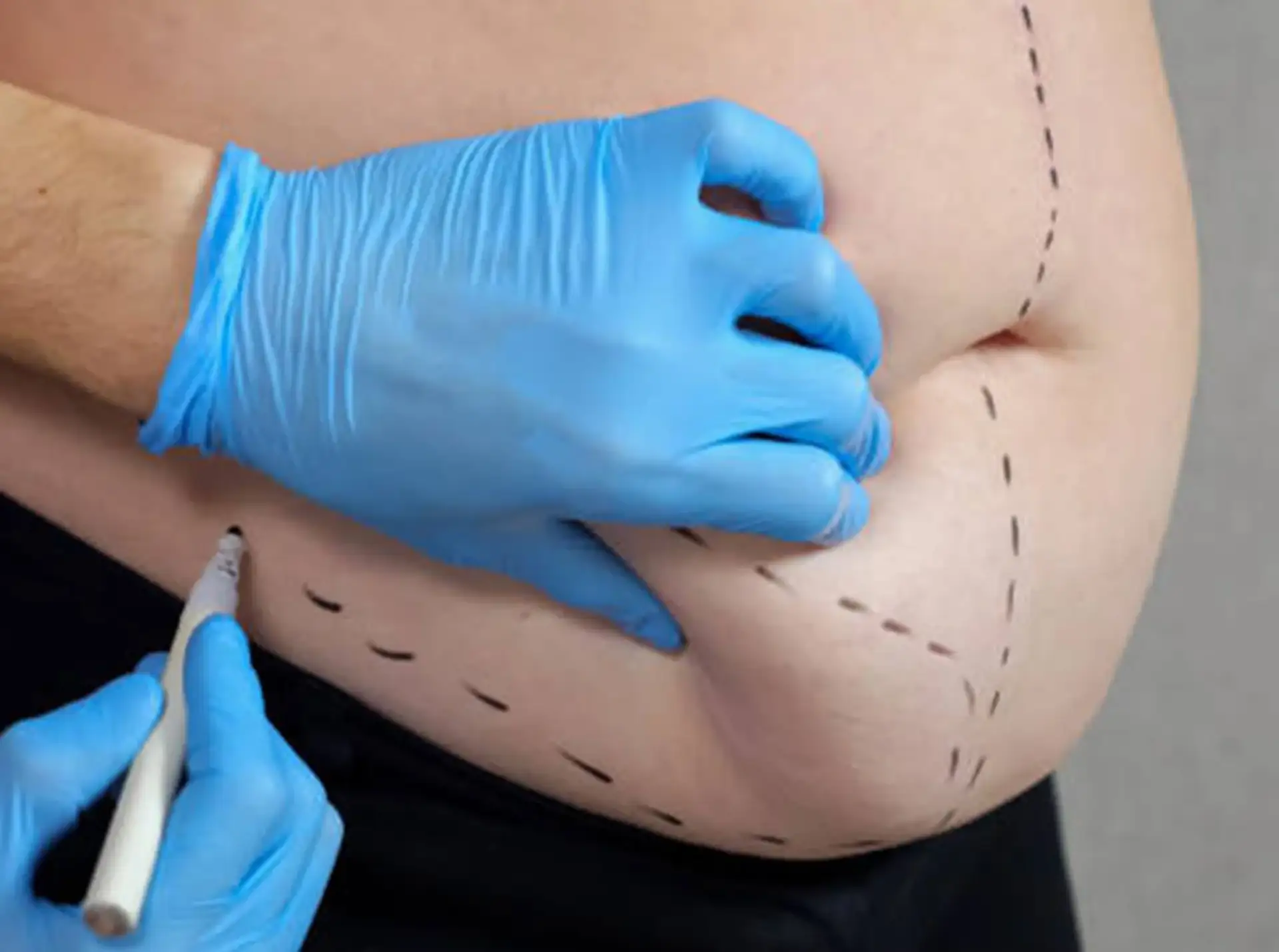 Un medico segna con una penna le aree per la liposuzione.