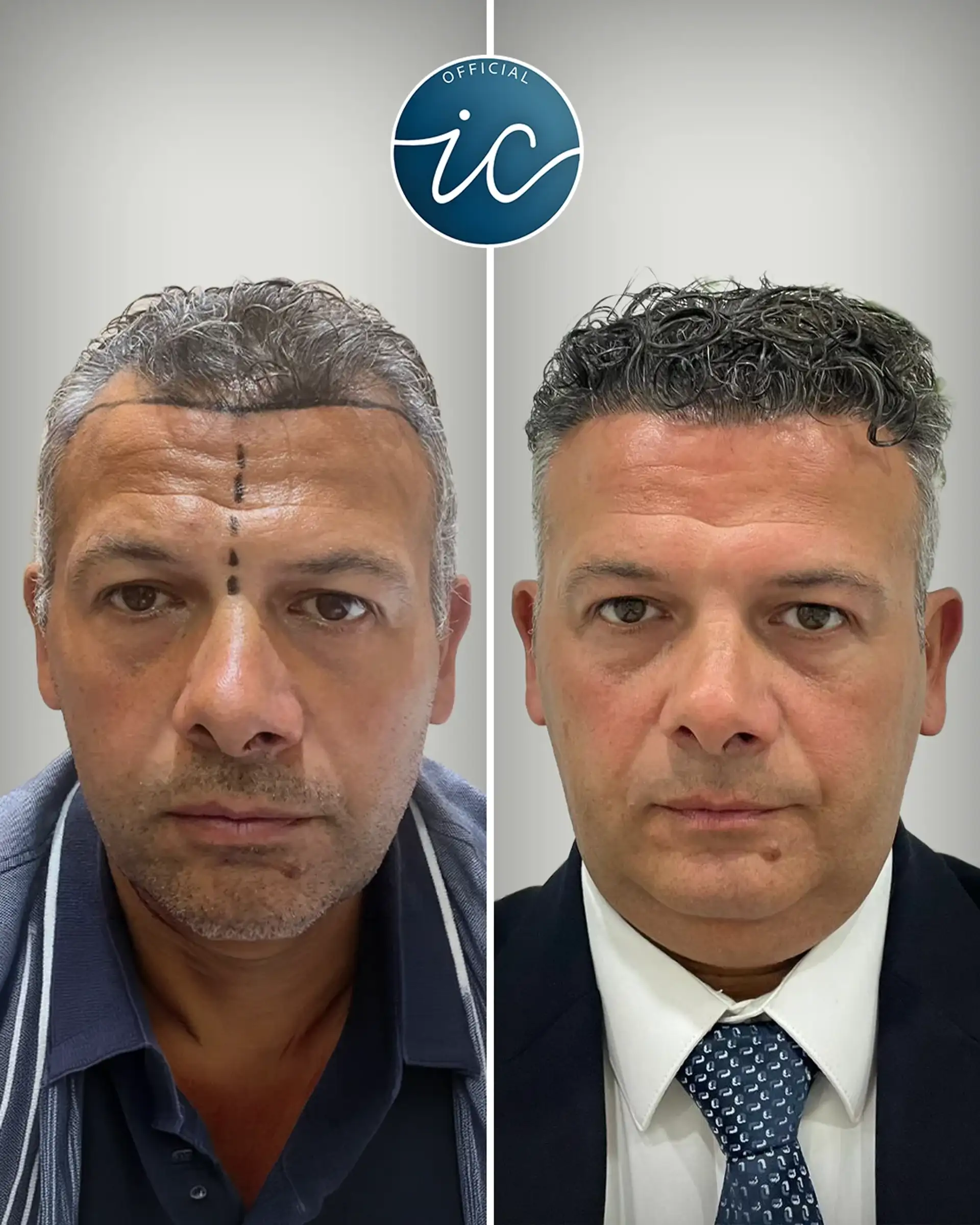 Trapianto Capelli in Turchia