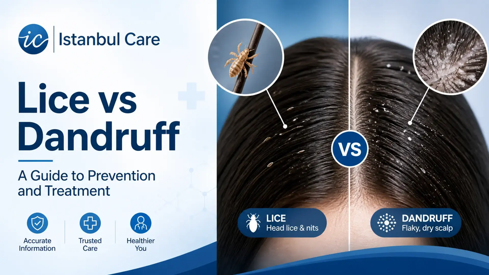 Lice vs Dandruff A Guide to Prevention and Treatment