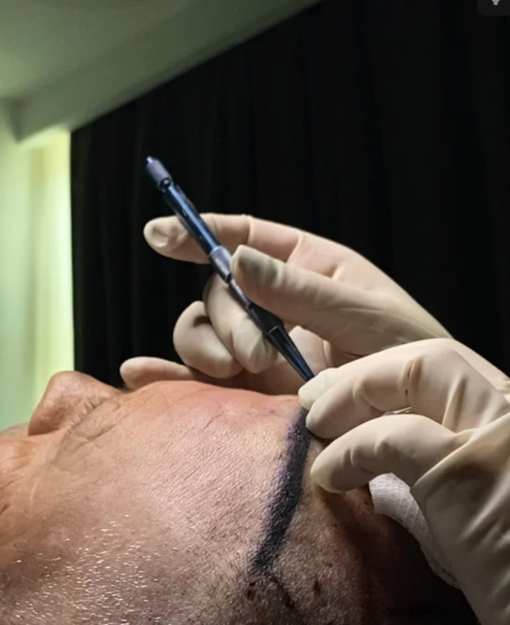 Using FUE Engines for Graft Extraction